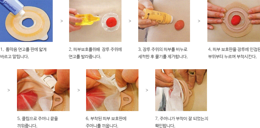 1. 틈막음 연고를 판에 얇게 바르고 말립니다. 2. 피부보호를위해  장루 주위에 연고를 발라줍니다. 3. 장루 주위의 피부를 비누로 세척한 후 물기를 제거합니다. 4. 피부 보호판을 장루에 인접된 부위부터 누르며 부착시킨다. 5. 클립으로 주머니 끝을 끼워줍니다. 6. 부착된 피부 보호판에 주머니를 끼웁니다. 7. 주머니가 부착이 잘 되었는지 확인합니다.