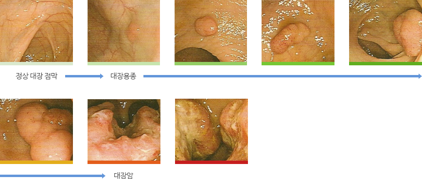대장 용종(선종)암 연속체